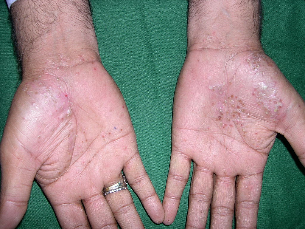 Psoriasis of the palms and soles | DermNet New Zealand