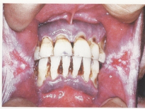 Medical White Patch On Gums